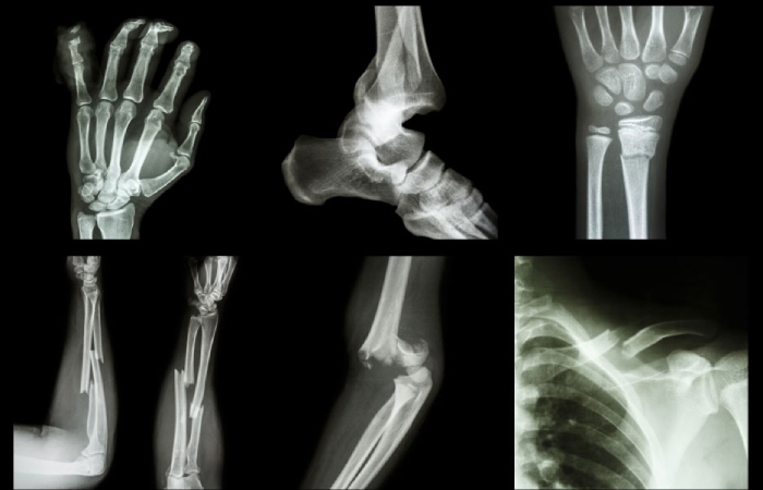 What is a Crushed Bone Injury_